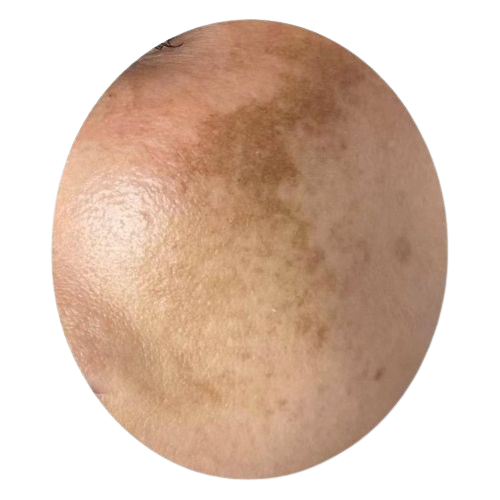 Dark Spots/Hyperpigmentation.