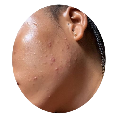 Oily or Acne-Prone Skin